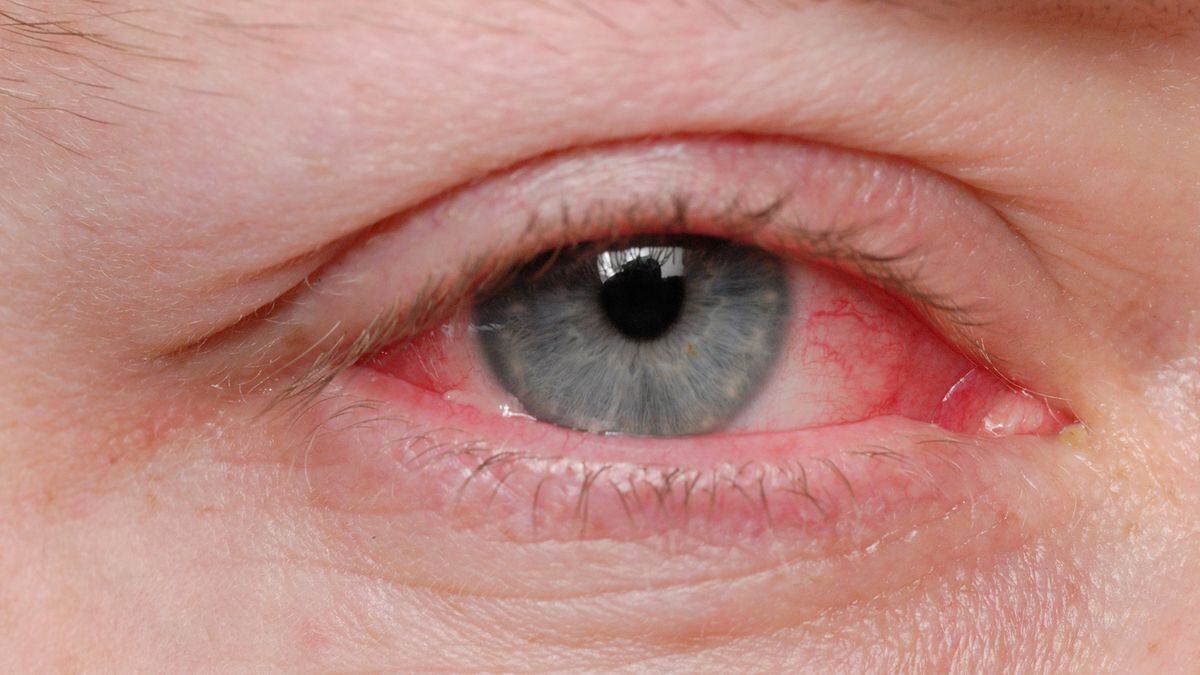 Coronavirus Pink eye could be rare symptom of COVID19